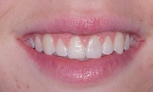 Crown Lengthening Case 1 After