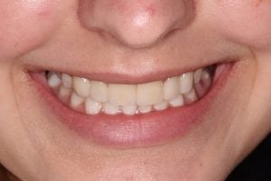 Crown Lengthening & Veneers Case 1 After