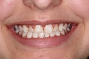 Crown Lengthening & Veneers Case 1 before