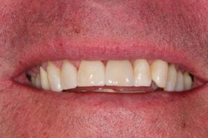 Dental Implant Case 2 After