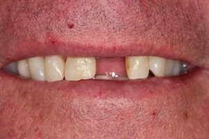 Dental Implant Case 2 Before