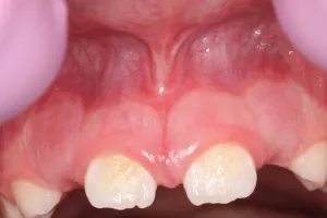 Frenectomy Case 1 After