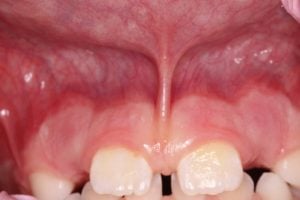 Frenectomy Case 1 Before