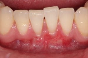 Gum Graft Case 1 After