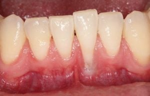 Gum Graft Case 1 Before
