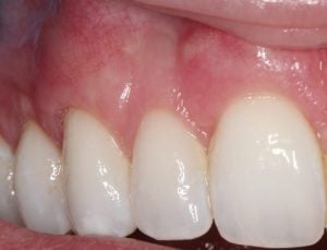 Gum Graft Case 2 After