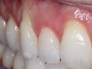 Gum Graft Case 2 Before