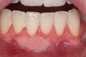 Gum Graft Case 3 After