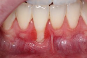 Gum Graft Case 3 Before