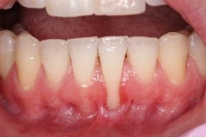 Gum Graft Case 4 After