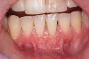 Gum Graft Case 4 Before