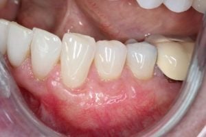 Gum Graft Case 5 After