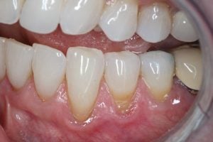 Gum Graft Case 5 Before