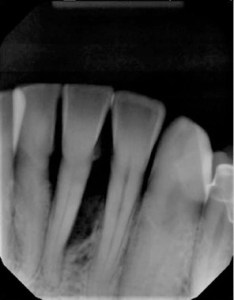 guided tissue regeneration case 1 Before