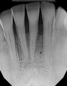 guided tissue regeneration case 1 After