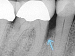 guided tissue regeneration case 3 Before