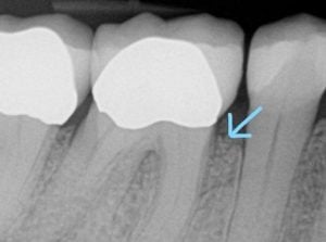 guided tissue regeneration case 3 After