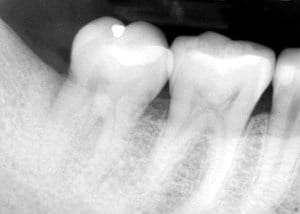 guided tissue regeneration case 2 After