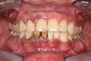periodontal disease before & after
