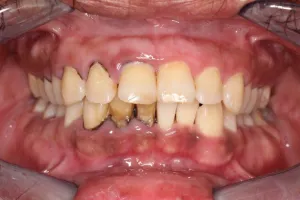 periodontal disease before & after
