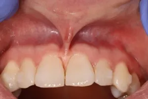 before frenectomy