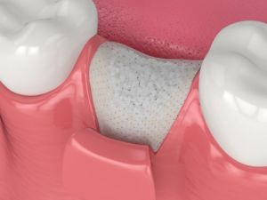 Bone Grafting example