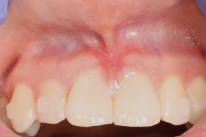 aftr frenectomy with waterlase