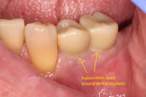 teeth before laser therapy