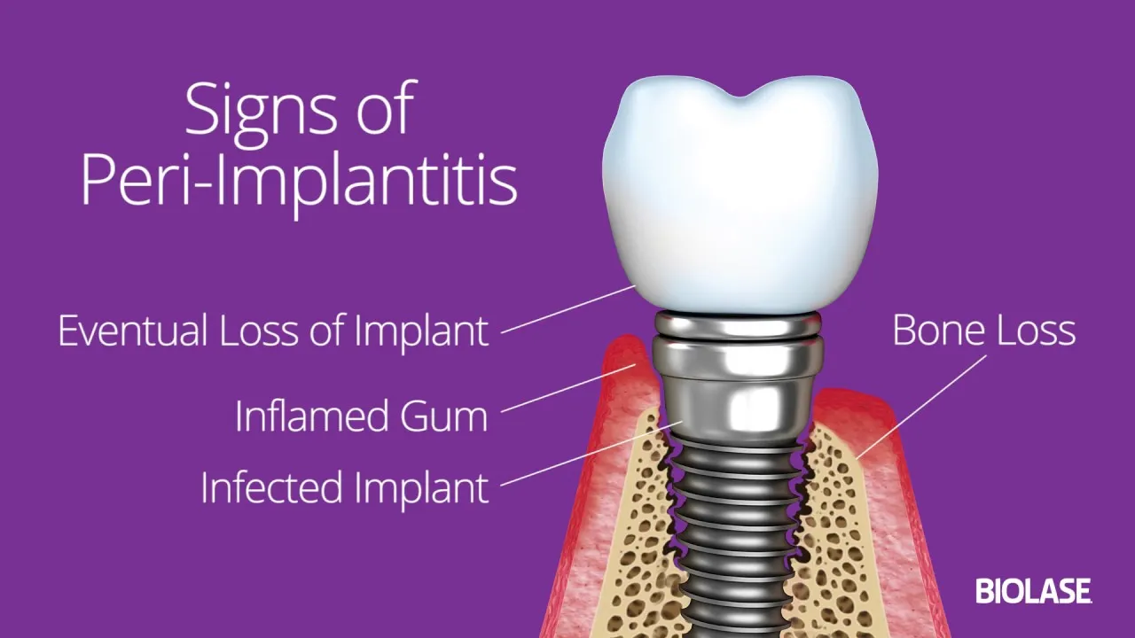 Peri-Implant Disease Management with Waterlase Dental Lasers BIOLASE Patient Education Video Thumbnail