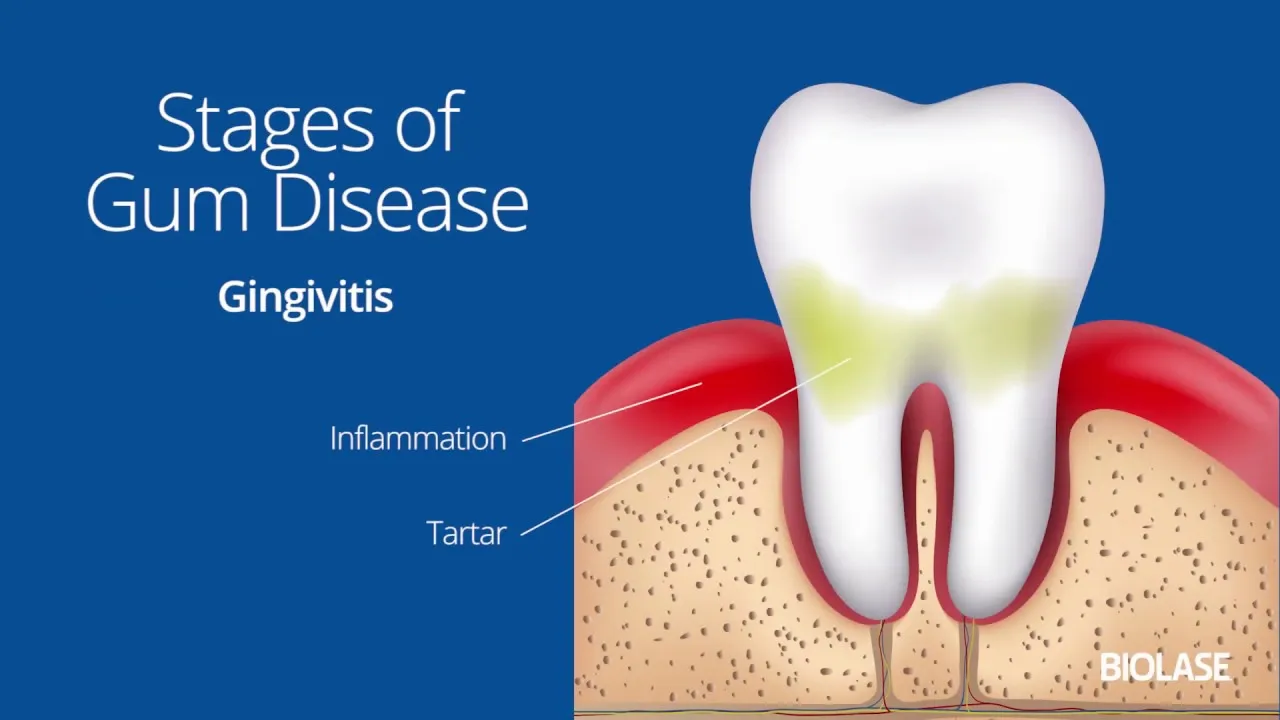 How Gum Disease is Treated with Waterlase BIOLASE Patient Education Video Thumbnail
