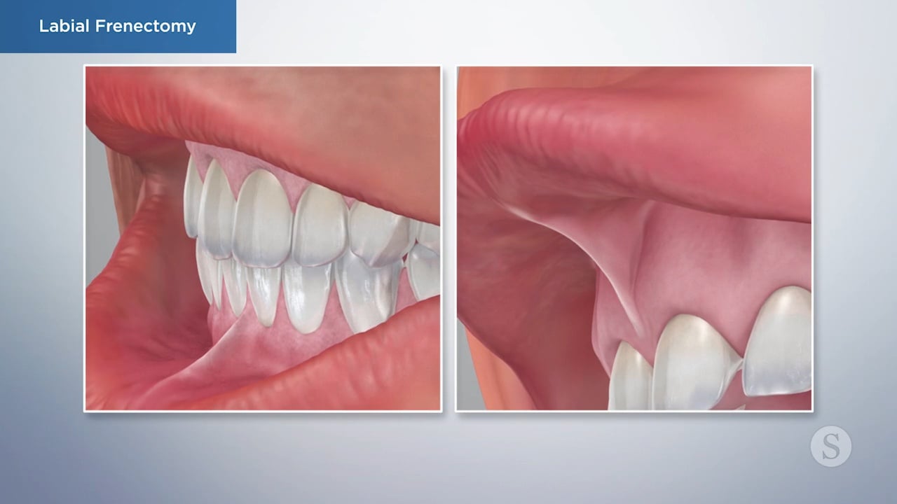 Tongue Tie / Frenectomy | Frenum Removal Surgery Woodbury, MN, image size:1280x720
