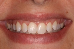 after crown lengthening