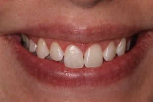 after crown lengthening