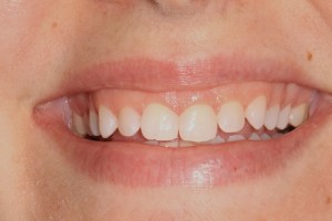 before crown lengthening