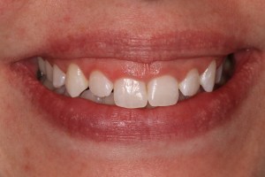 before crown lengthening
